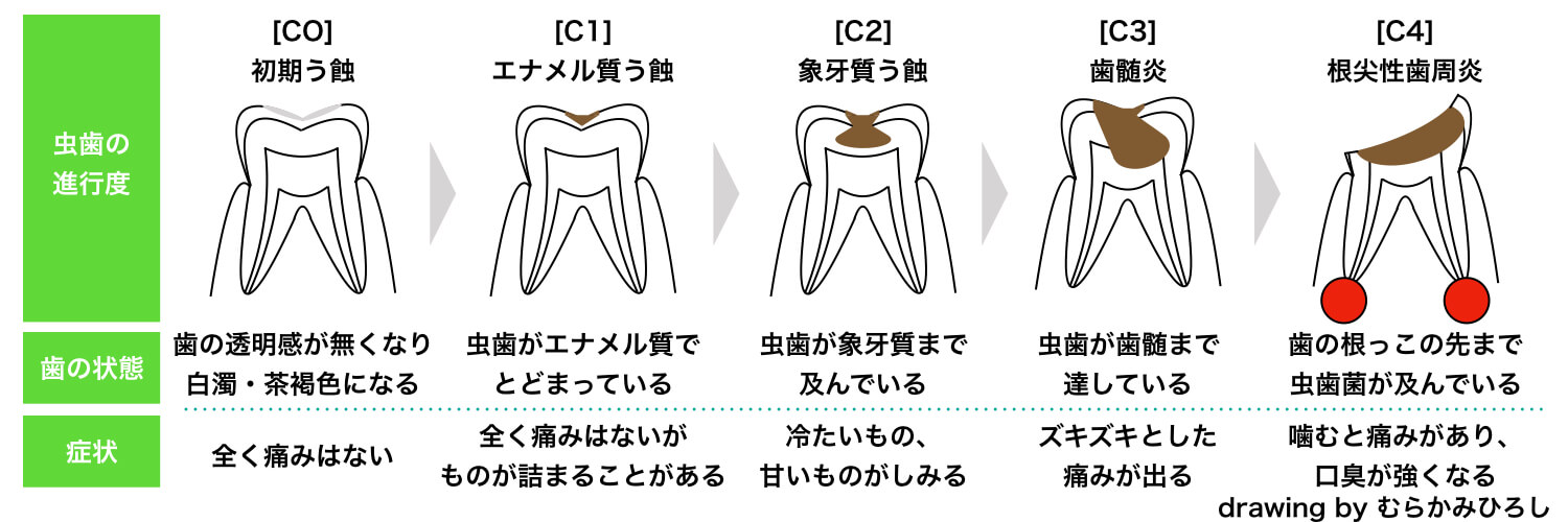 テキスト虫歯の進行
